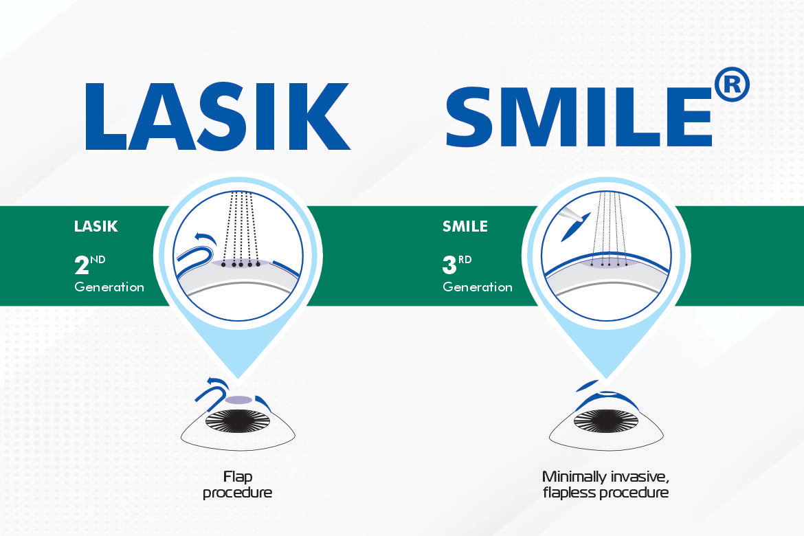 LASIK vs. SMILE