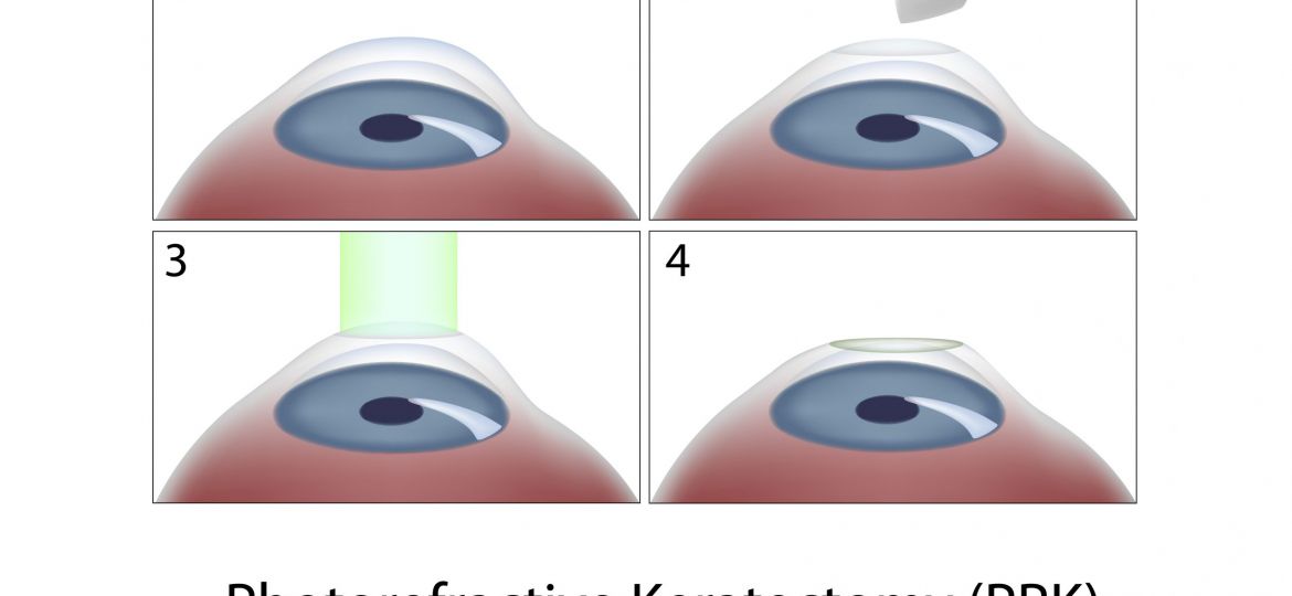 prk eye surgery procedure