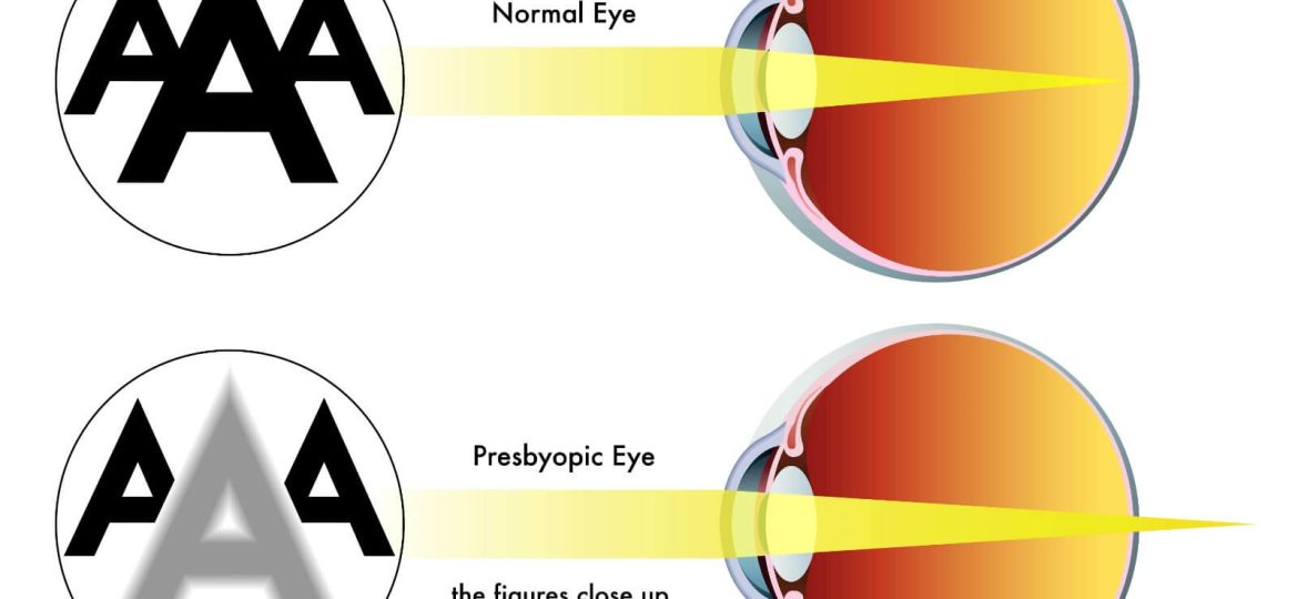 Presbyopia: Age-Related Vision Changes and Corrective Options