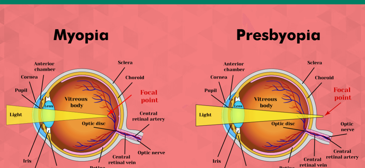 presbyopia vs myopia